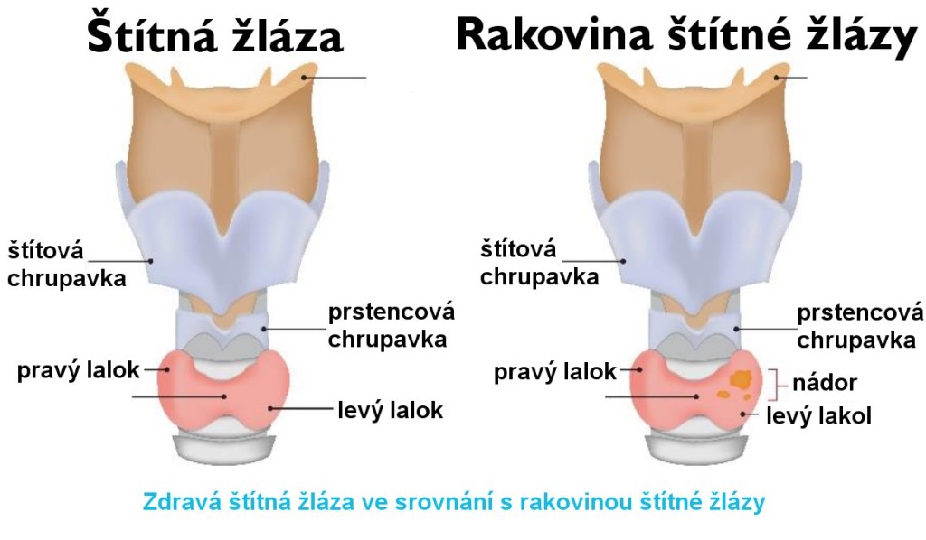 Vysoká dávka radioaktivního jódu-131 spojená s agresivním karcinomem štítné žlázy