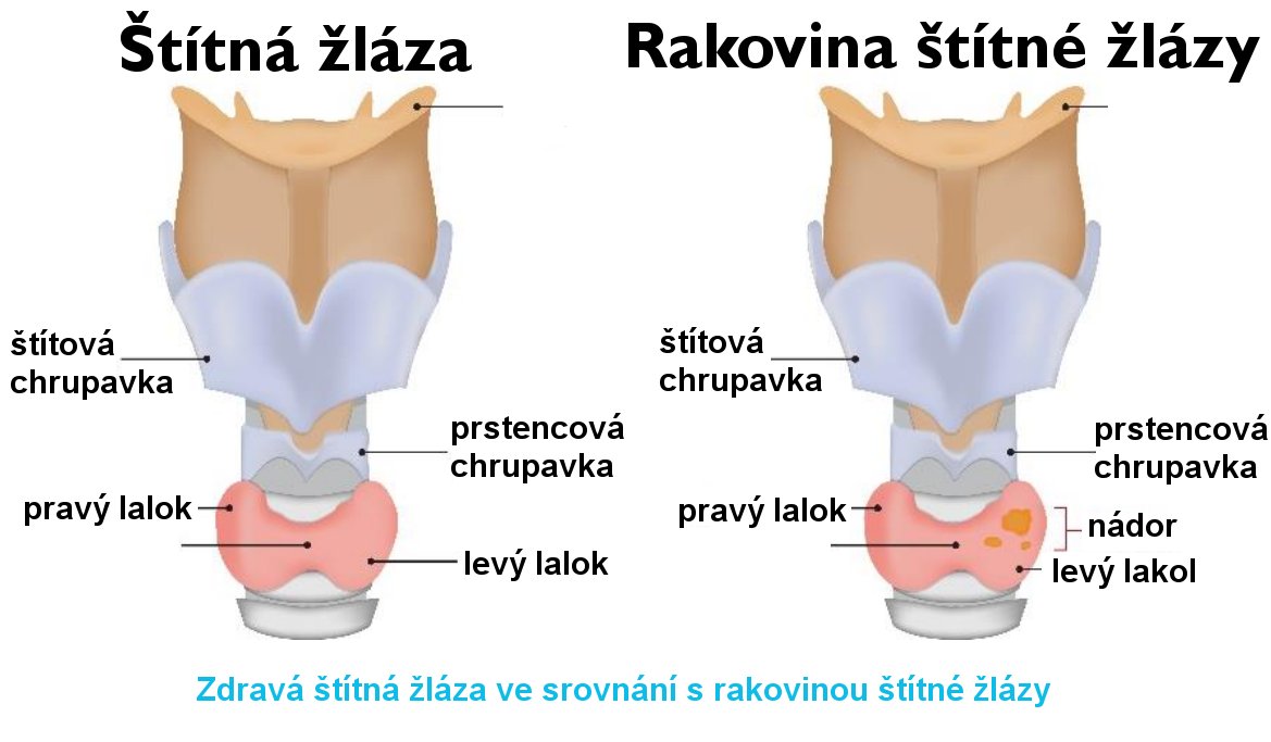 rakovina štítné žlázy